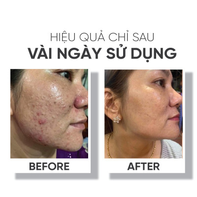 Nước hoa hồng giúp ngăn ngừa mụn, giảm nhờn cho da, da mịn màng  Lá House Acne Control Toner 100ml/200ml