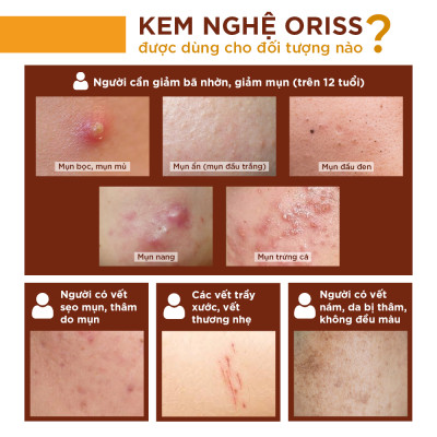 Kem Nghệ Giảm Mụn Oriss Giúp Mờ Thâm Sẹo Dưỡng Ẩm Sáng Da 20g