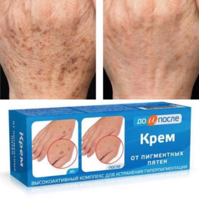 Kem chống đồi mồi Nga - Kem đồi mồi