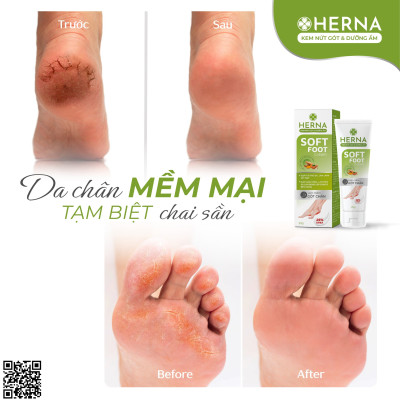 KEM NỨT GÓT & DƯỠNG ẨM Herna - Giúp cải thiện tình trạng da khô rát, nứt nẻ, bong tróc, sần sùi